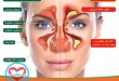 سینوزیت بیماری شایع و آزاردهنده و درمان های آن