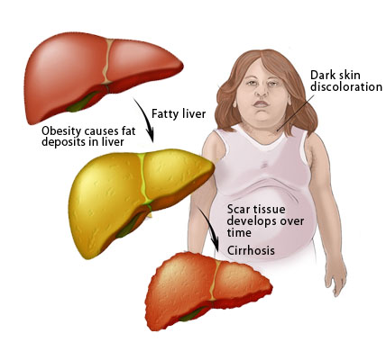 graphic-fatty-liver Ú©Ø¨Ø¯ Ú†Ø±Ø¨