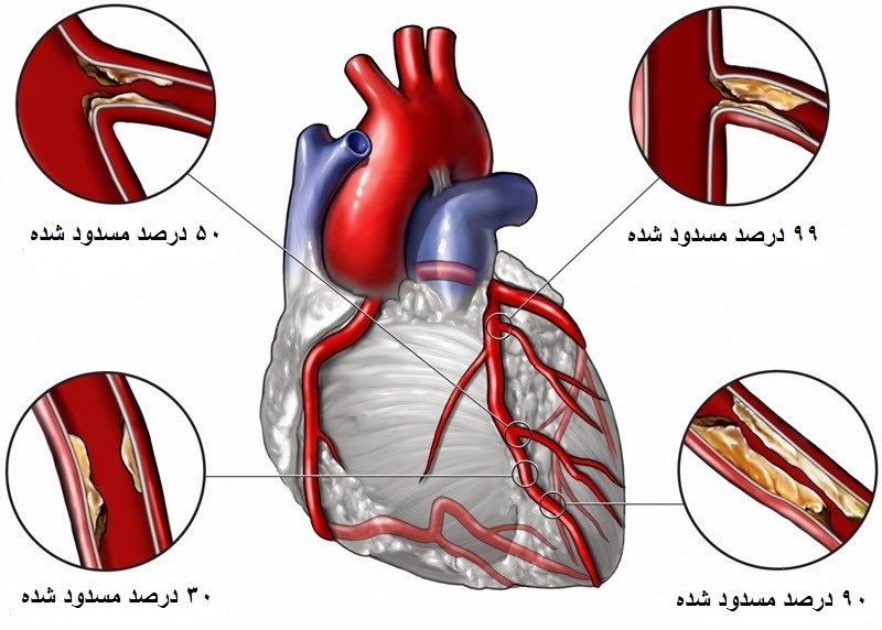 آنژیوگرافی عروق قلبی | سلامت دات لایف