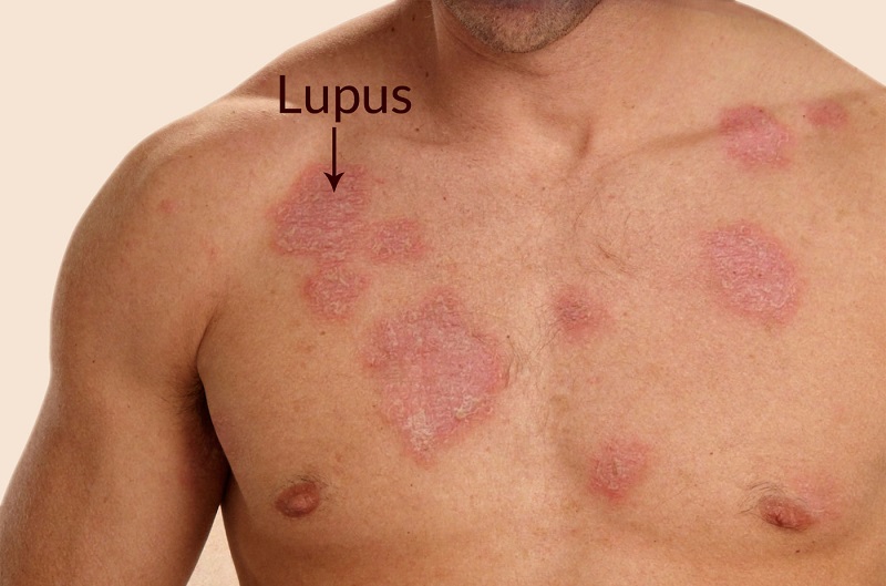 بیماری لوپوس