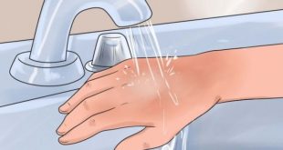 درمان سوختگی با آب