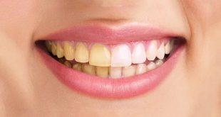 علت زردی دندان ها