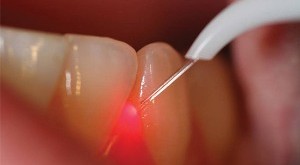 لیزر دندان پزشکی | سلامت دات لایف راهنمای زندگی سالم