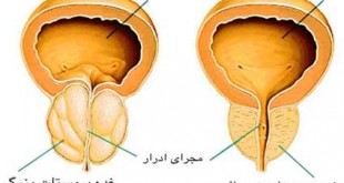 سرطان پروستات در مردان