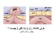 فتق کشاله ران | سلامت دات لایف
