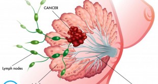 رژیم غذایی گیاهی و سرطان پستان