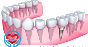 ایمپلنتهای دندانی | سلامت دات لایف راهنمای زندگی سالم