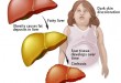 graphic-fatty-liver کبد چرب