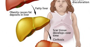 graphic-fatty-liver کبد چرب