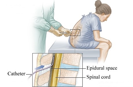 بی حسی ناحیه ایی اسپاینال Spinal