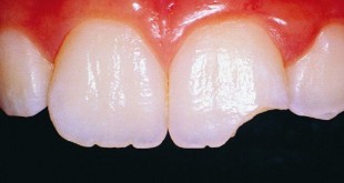 خرد شدن دندان