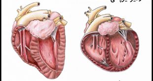 cardiomyopathy | کاردیومیوپاتی