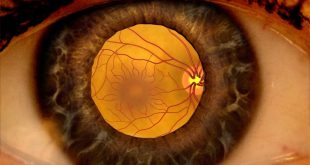 بیماری رتینوپاتی دیابتی یا چشم دیابتیک
