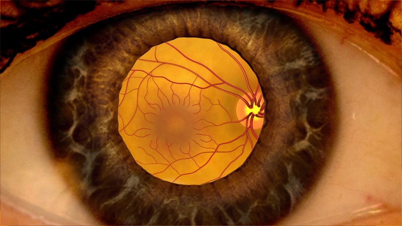بیماری رتینوپاتی دیابتی یا چشم دیابتیک