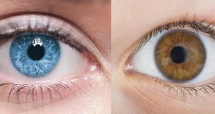 تغییر رنگ چشم با ایمپلنت عنبیه مصنوعی