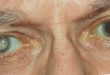 Cataract آب مروارید
