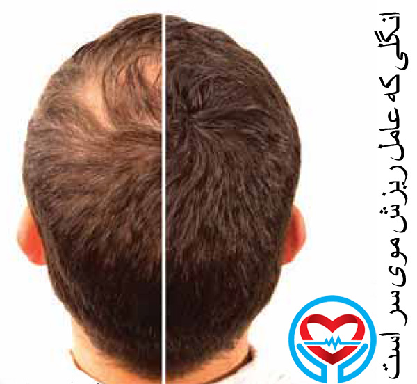 انگل دمودکس عامل ریزش موی سر