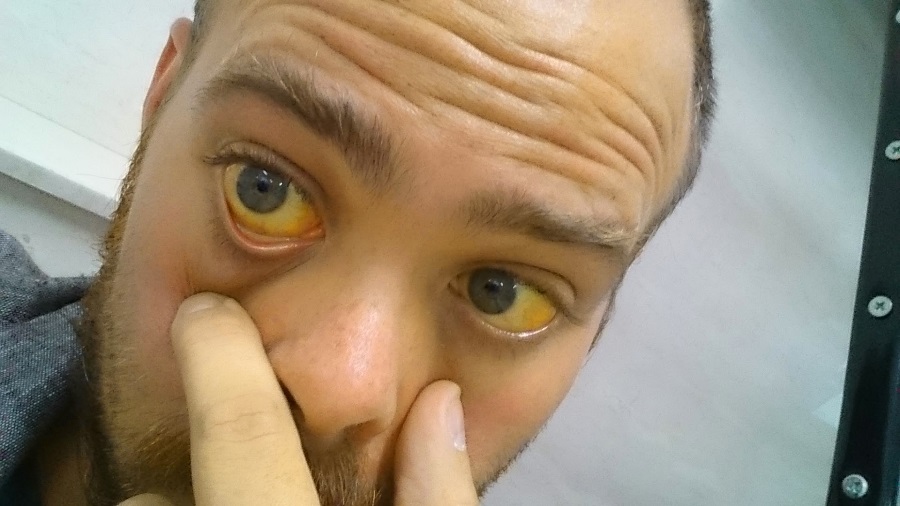 علایم بیماری زردی