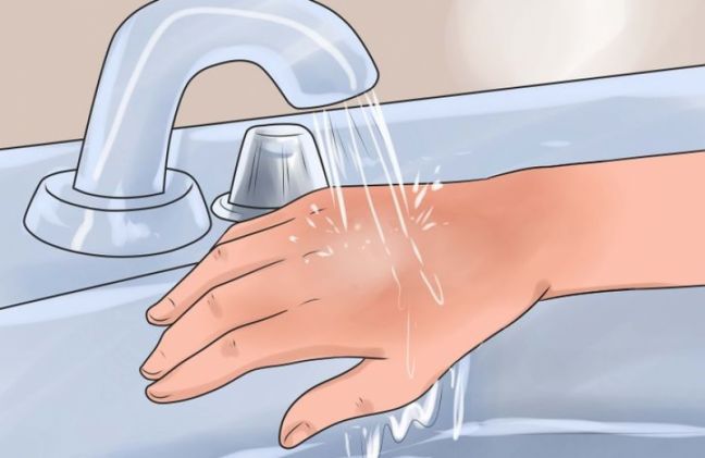 درمان سوختگی با آب