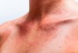 اثرات دیررس آفتاب برروی پوست