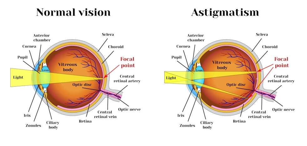 آستیگماتیسم چشم چیست و چه علائم و درمانی دارد